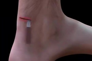 看著都疼！科普視頻：球員腳跟腱斷裂是如何進行修復的？